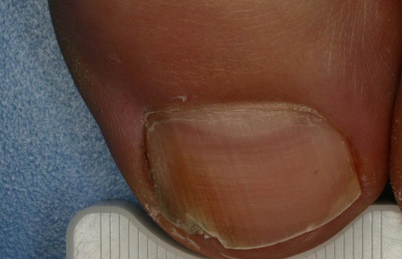 Hongos en las uñas