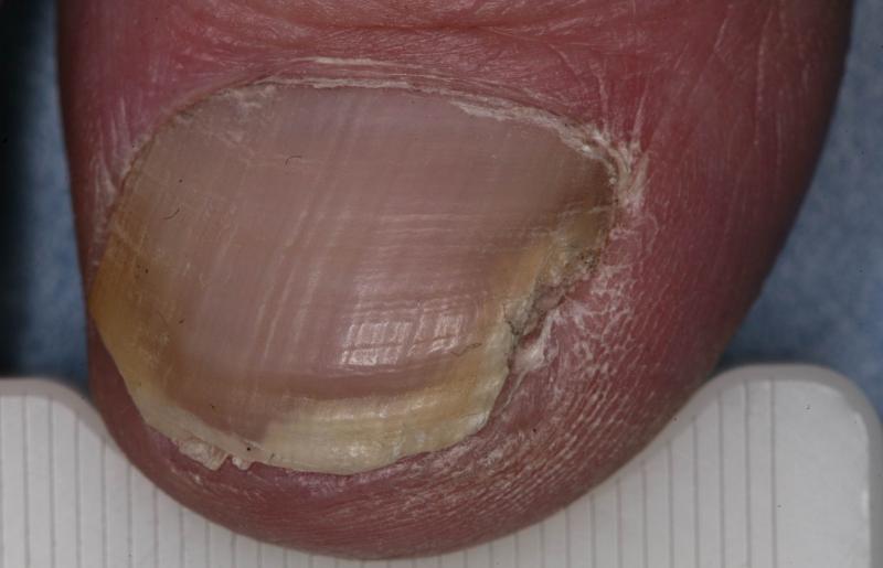 Hongos en las uñas