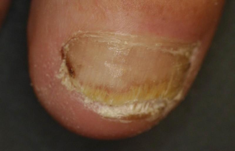Hongos en las uñas